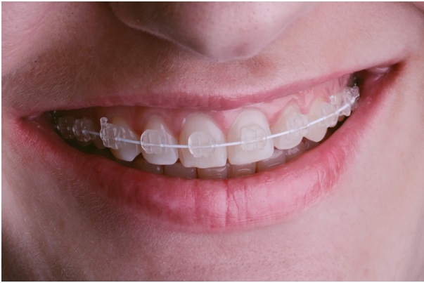 Different Types of Braces