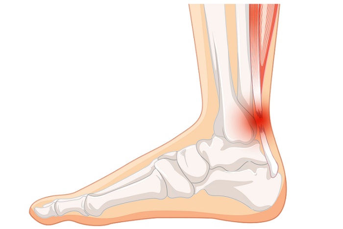 Tips for Recovering From High Ankle Sprains