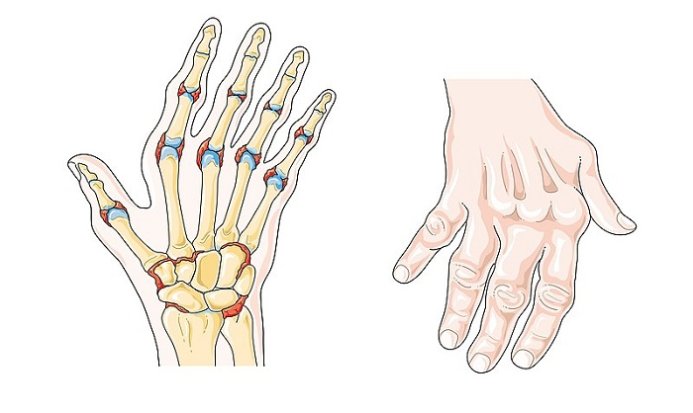 Rheumatoid_arthritis (1)